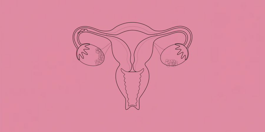 El Síndrome de Ovario Poliquístico, sus matices y cómo mejorar sus síntomas